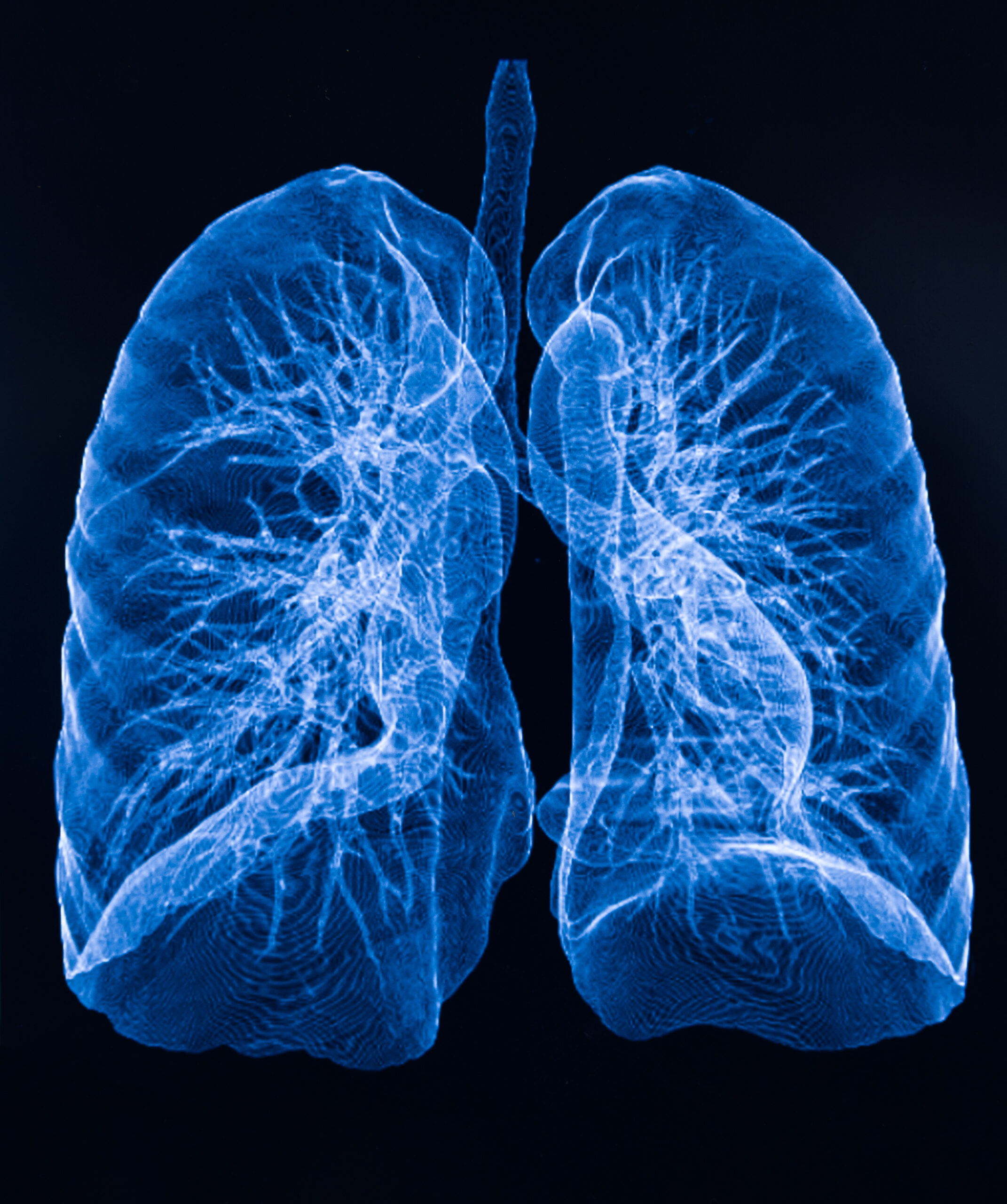 Lung Ultrasound